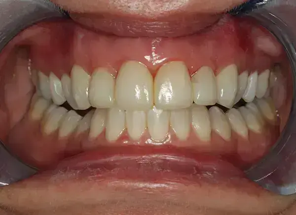 Porcelain Veneers después