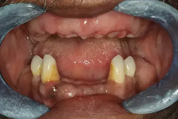 Complete Dentures después